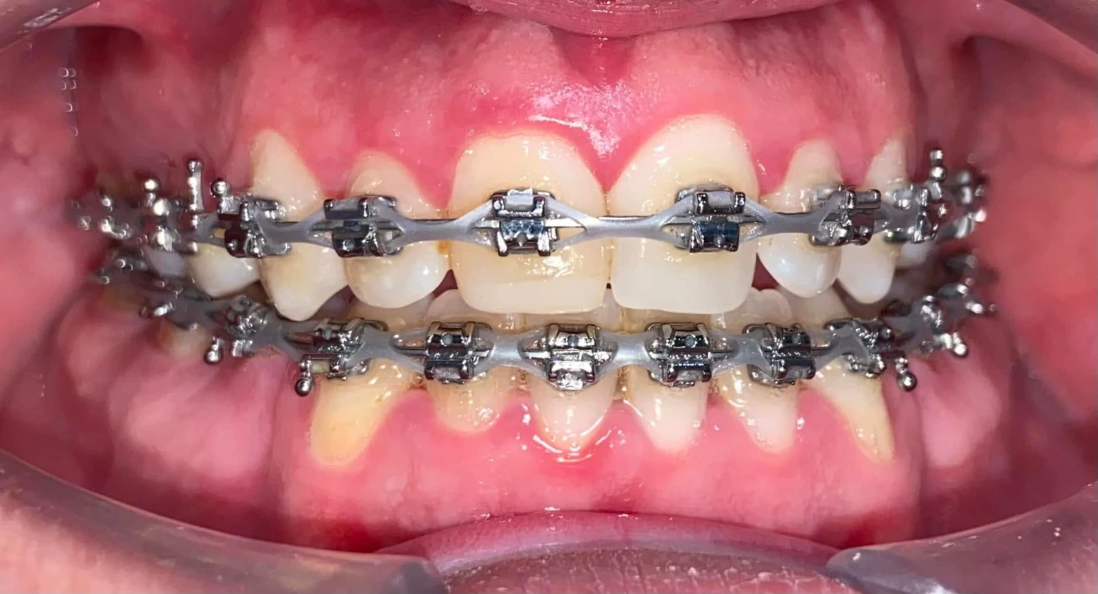 Ortodoncia: vista frontal, fotografía de referencia de la página de Orthoned
