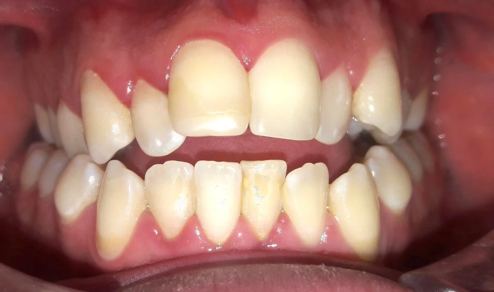 Registro dental frontal, fotografía de referencia de la página de Orthoned