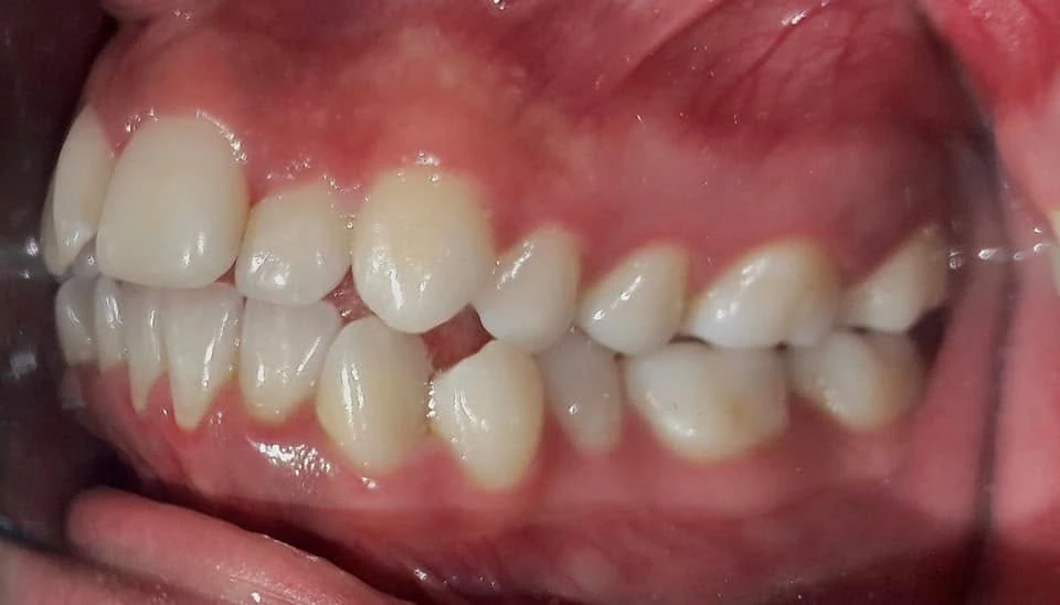 Registro dental lateral, fotografía de referencia de la página de Orthoned