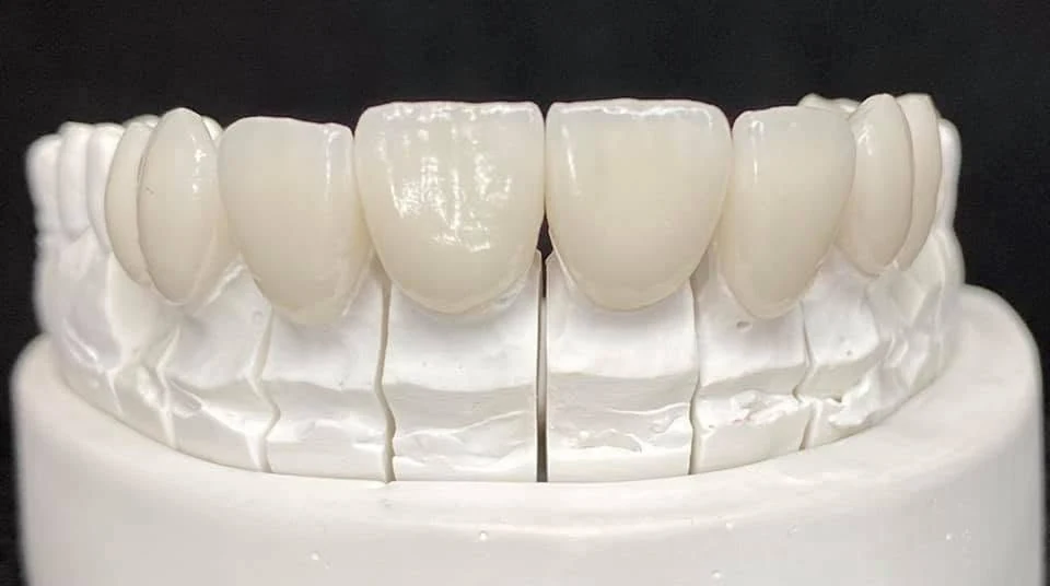 Modelo dental, fotografía de referencia de la página de Orthoned